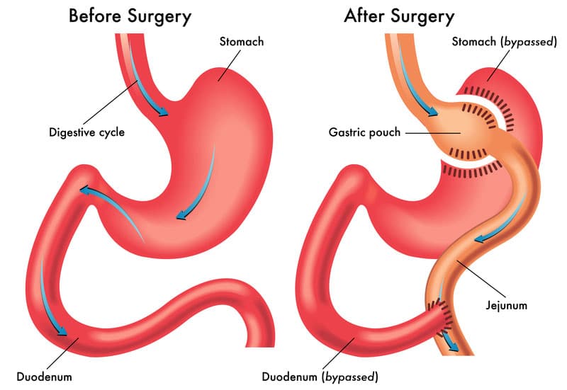 Gastric Bypass - maagverkleining