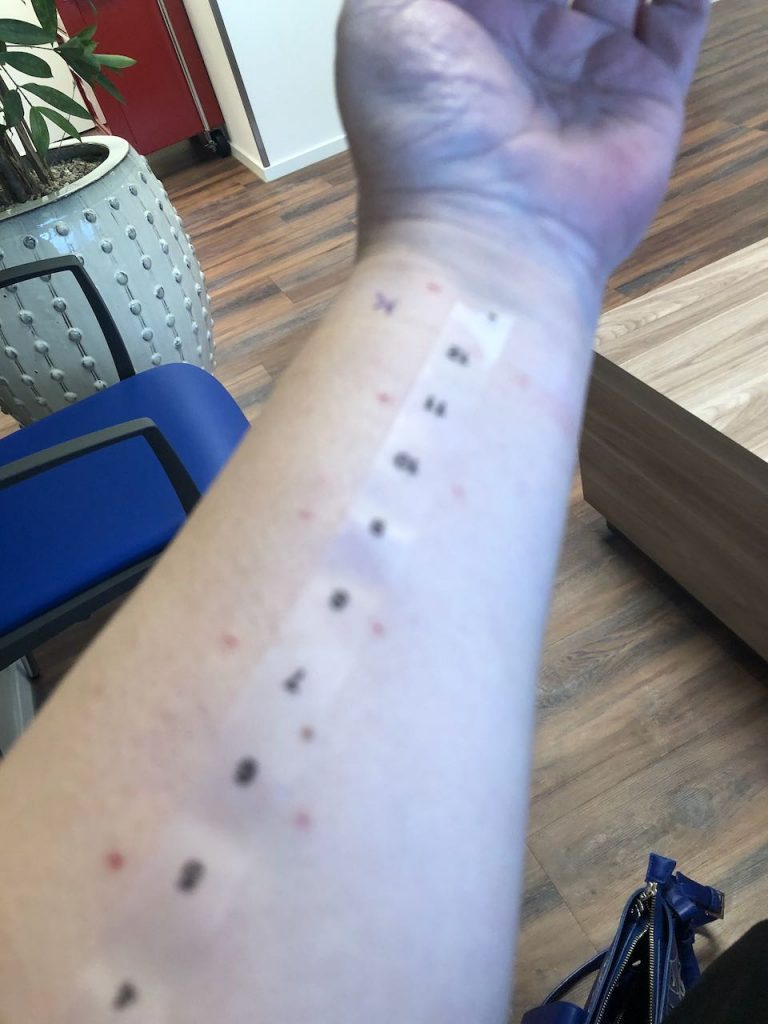 Allergietest
